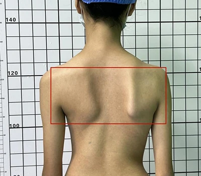 Comprehensive Scoliosis Assessment: Understanding, Identifying, and Addressing Spinal Health