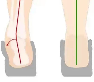Heel Eversion and Heel Inversion Assessment: Clinical Evaluation, Practical Applications, and Com...