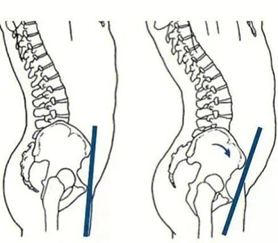 Anterior Pelvic Tilt Assessment: Causes, Risks, Evaluation Methods, and Commercial Applications