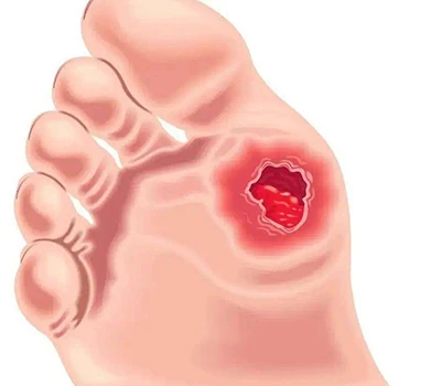 Diabetic Foot Assessment: Clinical Insight, Risk Management, and Commercial Opportunities