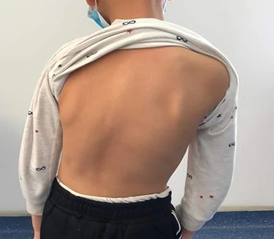 Scoliosis Screening and Management: How Xianku 3D Body Scanner Assists Chiropractors