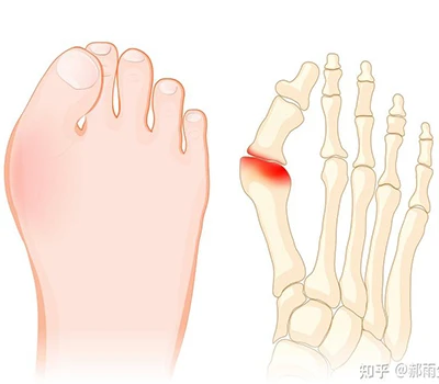 Hallux Valgus: A Complete Science Guide