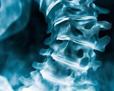 AI Scoliosis Screening And Spinal Alignment Tracking: A Smarter 3D Health Screening Solution For ...
