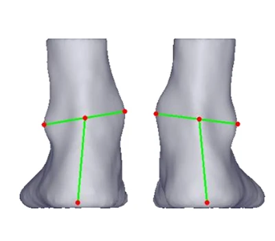 Heel Valgus And Varus: A Silent Threat Across