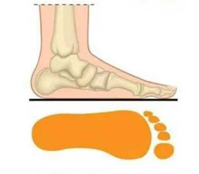Flat Foot Screening: Manual Checks Vs. Pressure Mats Vs. 3D AI Scanners