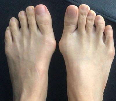 The Hallux Valgus Measurement: Why 3D Scanners Are Outpacing Clinicians And Hospitals