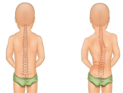 New Scoliosis Screening Method: AI & 3D Digital Spine