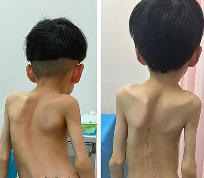 Spinal Health: The Role Of 3D Body Scanning Technology in Scoliosis Assessment And Market Transfo...