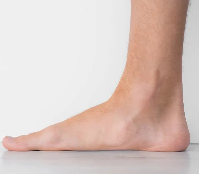 The Silent Epidemic: Understanding Flat Feet And Technological Solutions For A Global Foot Health...