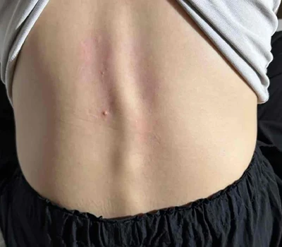 Comprehensive Analysis Of Scoliosis: Understanding The Condition And Technological Innovations in...