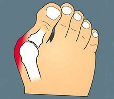 Transforming Bunion Care: Integrating Precision Scanning For Enhanced Customization, Patient Enga...