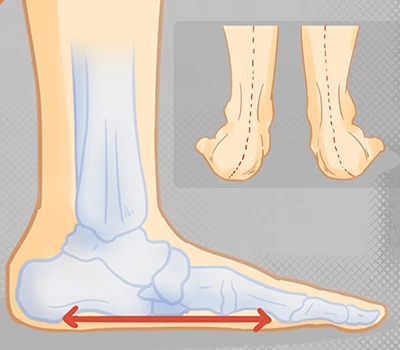 Flat Feet: The Silent Health Concern Affecting Millions And How Modern Technology Offers A Solution