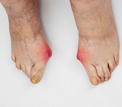 Diabetic Foot Prevention – How 3D Scanning Enables Early Intervention in Healthcare